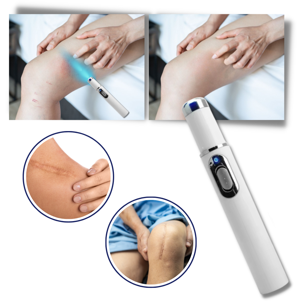  Dark Spot Remover Blue Laser Pen - Ozerty