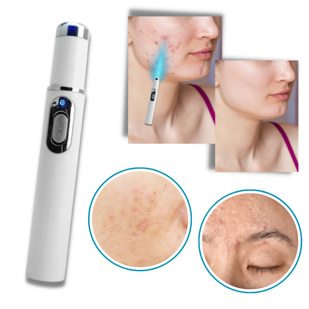  Dark Spot Remover Blue Laser Pen - Ozerty